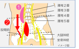 腰痛から坐骨神経痛・痺れに。